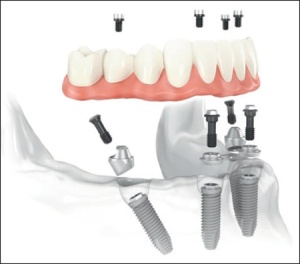 Fixed teeth using Dental Implants